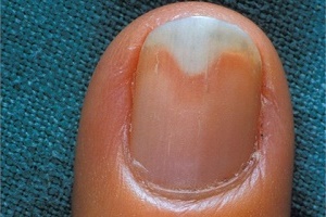 Причины расслоения ногтей