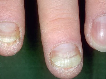 Причины расслоения ногтей